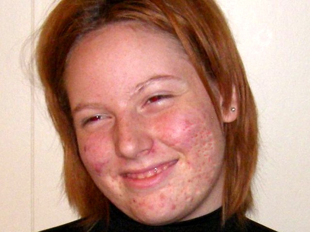 5 Natural Acne Treatments That Avoid Pharmaceuticals That Only Mask The Problem