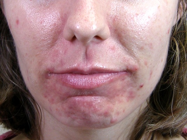 Getting Rid of Acne Scars